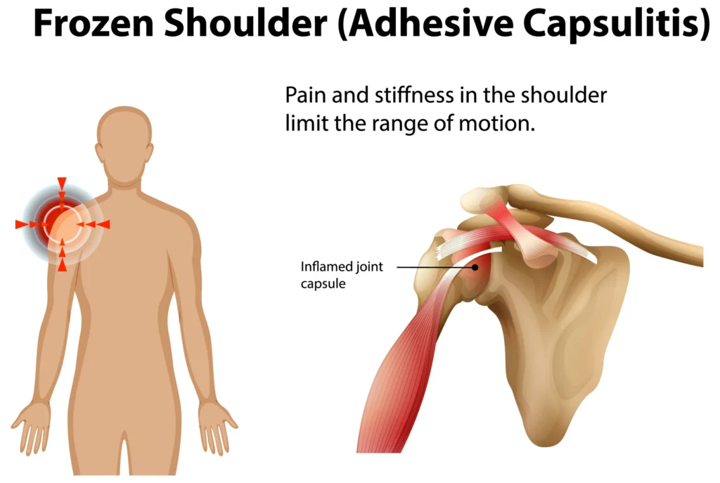 Illustration showing frozen shoulder and an inflamed shoulder joint capsule.